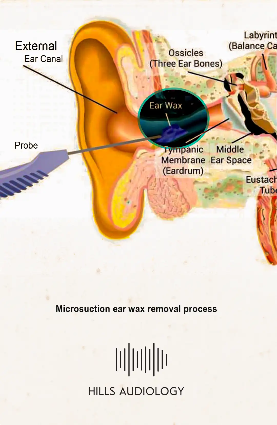 Microsuction ear wax removal